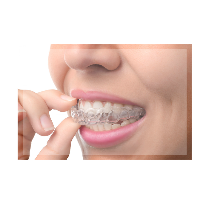 Invisalign Cost Carlsbad